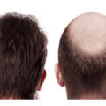 Hair Transplant cost in Istanbul