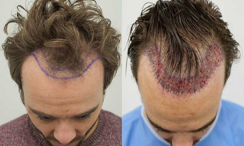 How much does a hair transplant cost in Istanbul?