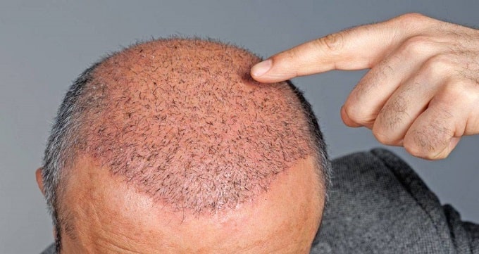 In which method is the cost of hair transplant in Istanbul lower?