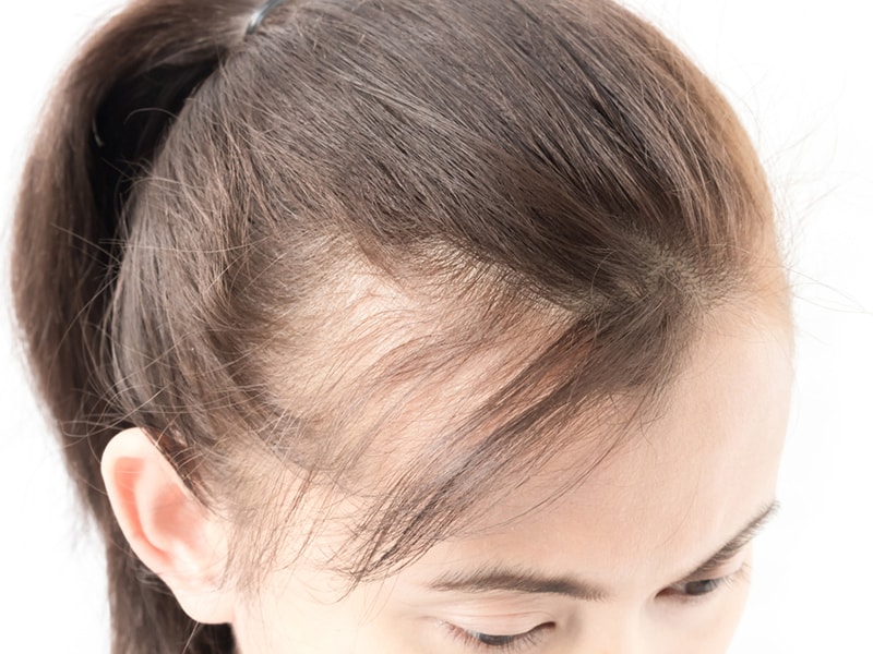 Is the hair transplant cost in Istanbul different for women and men?