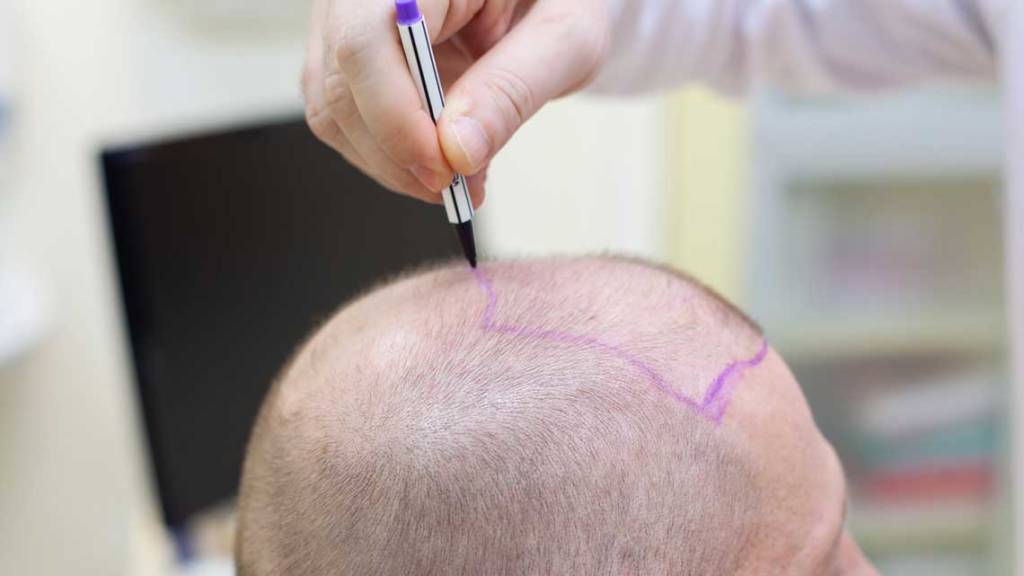 The age of the client is another factor influencing the hair transplant cost in Istanbul